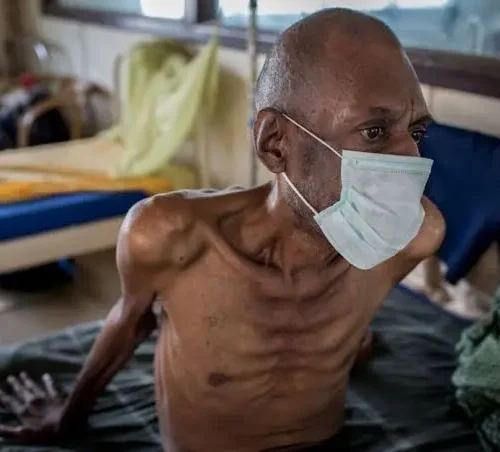 Tuberculosis (TB) in Sub-Saharan Africa