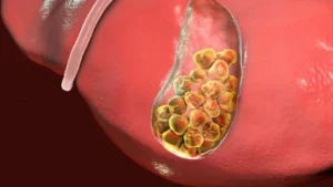 Gallstones are hardened lumps that form in the gallbladder, a small organ under your liver that stores bile (a digestive fluid).