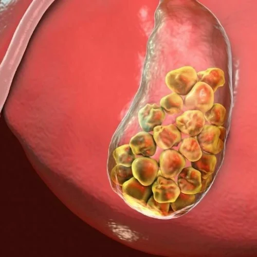 Gallstones