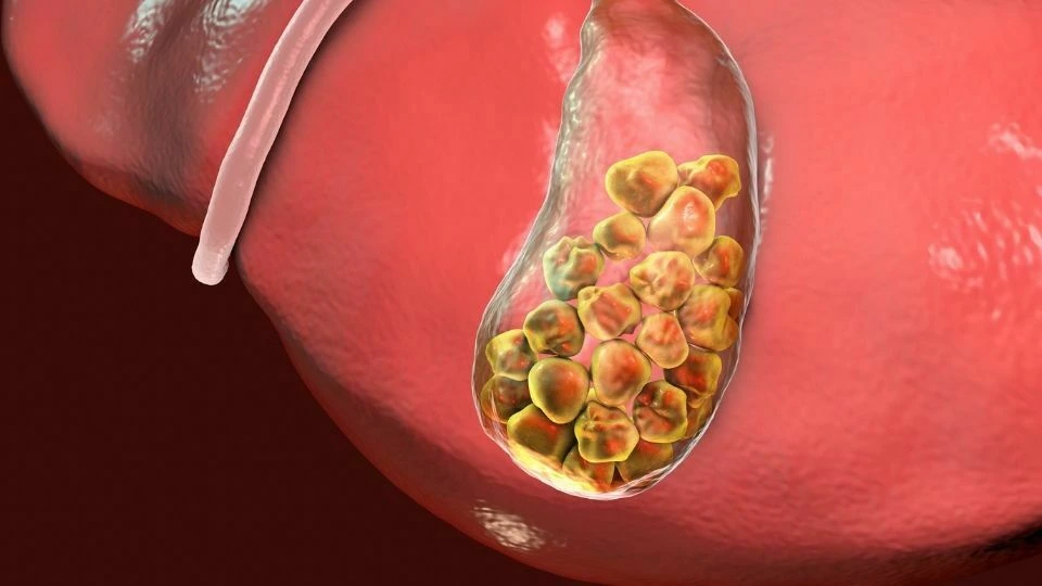 Gallstones are hardened lumps that form in the gallbladder, a small organ under your liver that stores bile (a digestive fluid).
