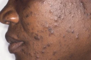 Acne is a common skin condition where small bumps, pimples, or spots appear on the skin due to clogged or inflamed oil glands (sebaceous glands).