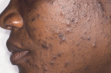 Acne is a common skin condition where small bumps, pimples, or spots appear on the skin due to clogged or inflamed oil glands (sebaceous glands).