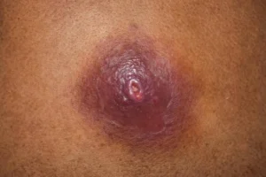 A boil is a painful, red lump on the skin filled with pus (thick yellow or white fluid). Boils are caused by bacteria (germs)