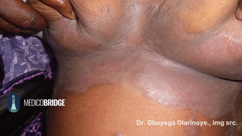 Erythrasma (also called cutaneous erythrasma) is a long-lasting skin infection caused by a bacteria called Corynebacterium minutissimum. It is very common in Sub-Saharan Africa because of the hot weather and moist skin.