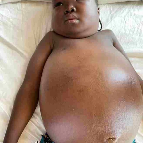 Understanding Wilms’ Tumour (Nephroblastoma)