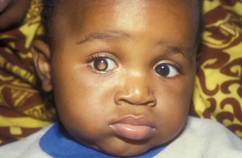 Retinoblastoma: Understanding and Managing Eye Cancer in Children A guide for parents and caregivers in sub-Saharan Africa