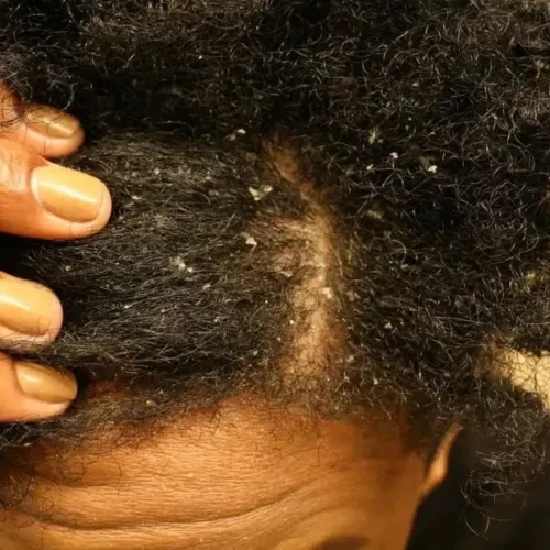 Head Lice (Pediculosis Capitis)
