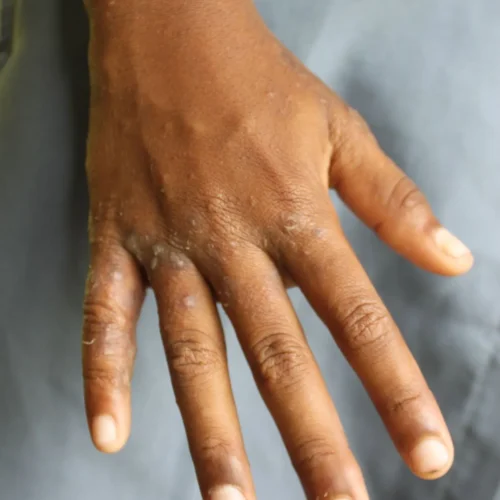 Scabies
