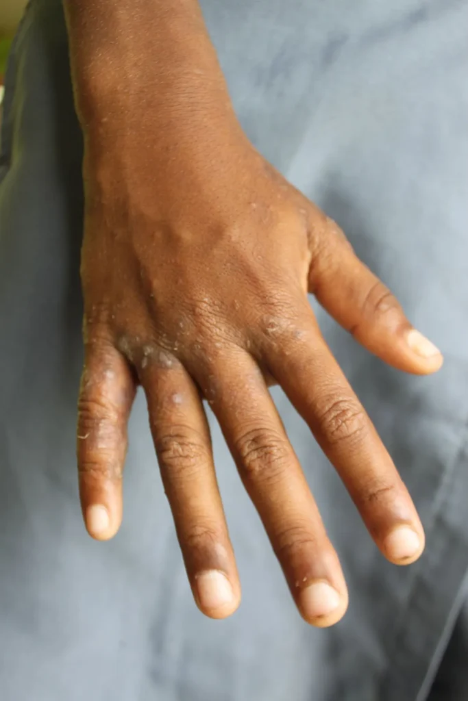 Patient Information: Scabies (Adapted for Sub-Saharan Africa)
