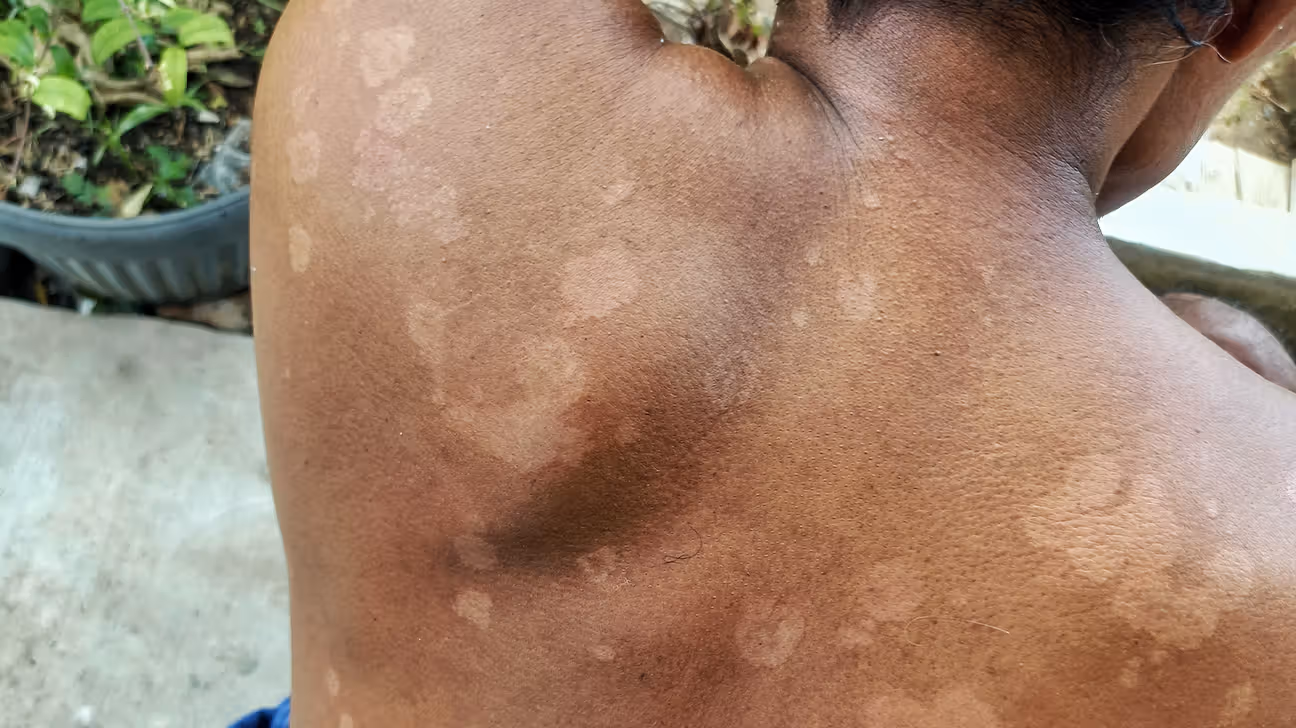 Tinea Versicolor (Discolored Skin Patches)