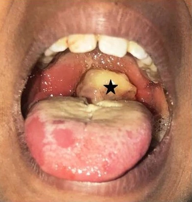 Diphtheria is a contagious bacterial infection caused by Corynebacterium diphtheriae. It mainly affects the throat and nose (respiratory diphtheria)