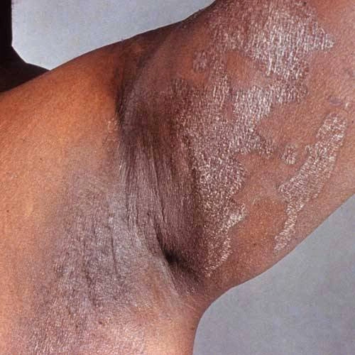 Erythrasma (Skin fold infection) (Adapted for Sub-Saharan Africa)