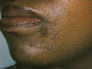 A long-term skin condition that causes redness, dark patches, bumps, and burning on the face (cheeks, nose, forehead, chin).