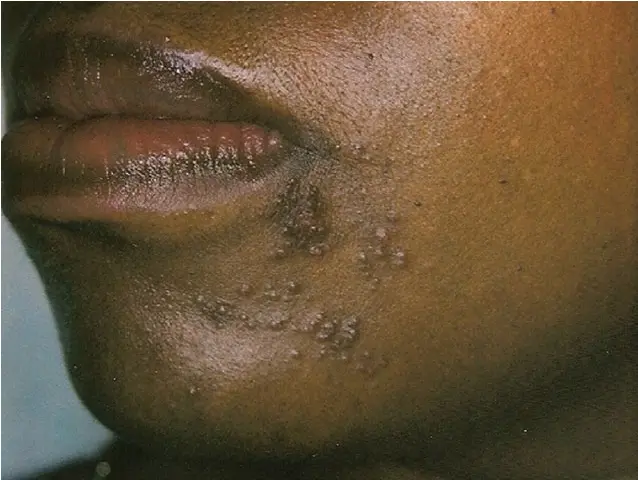 A long-term skin condition that causes redness, dark patches, bumps, and burning on the face (cheeks, nose, forehead, chin).