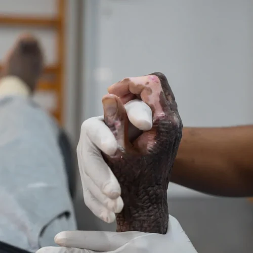 Burns Management in Sub-Saharan Africa